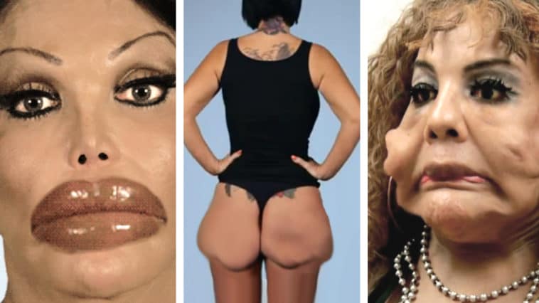 Top WORST Plastic Surgery Disasters